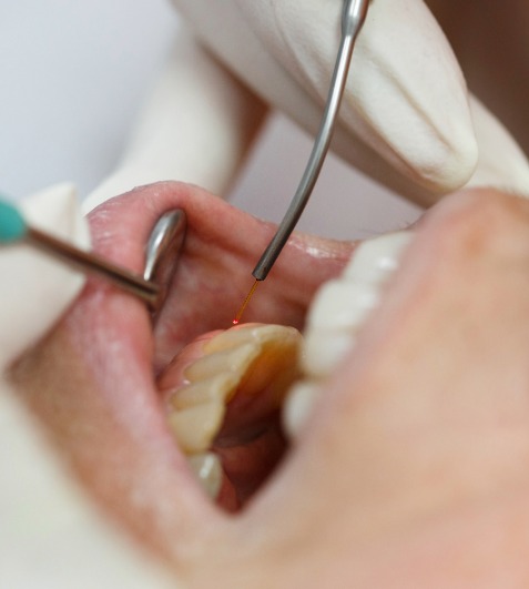 Laser Assisted Soft Tissue Surgery